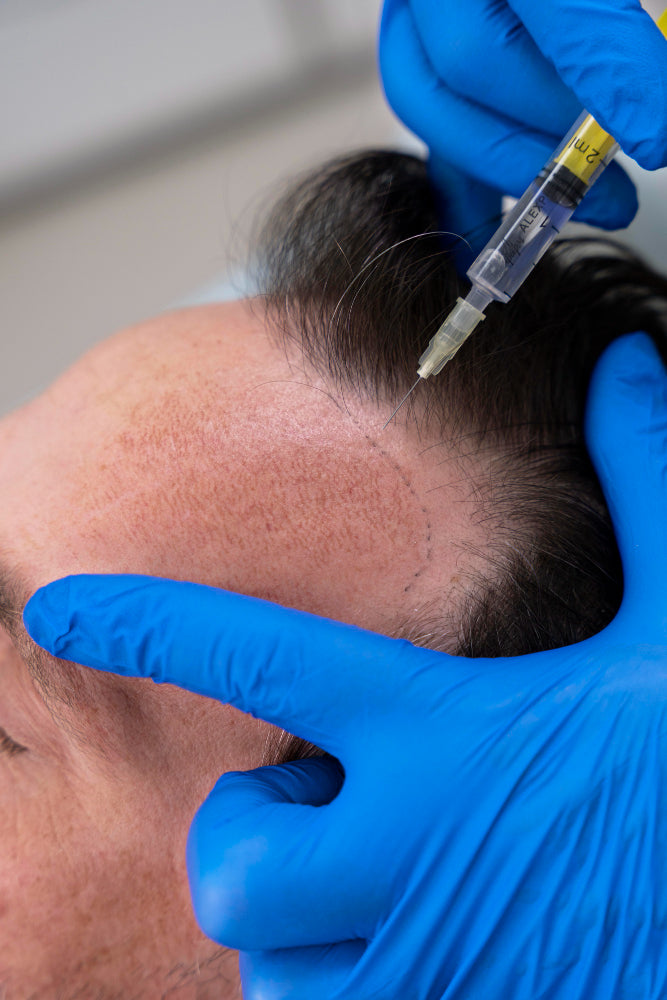 Hair Transplant (FUE)